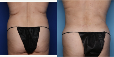 Case 1043 - 45-54 year old woman treated with Mommy Makeover, Breast Lift, Tummy Tuck