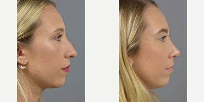 Case 10430 - Woman treated with Rhinoplasty, Septoplasty