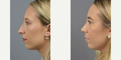 Case 10431 - Woman treated with Rhinoplasty, Septoplasty