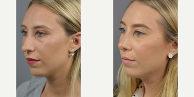 Case 10432 - Woman treated with Rhinoplasty, Septoplasty
