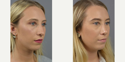 Case 10433 - Woman treated with Rhinoplasty, Septoplasty