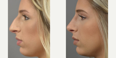 Case 10434 - Woman treated with Rhinoplasty, Septoplasty