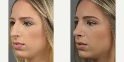 Case 10435 - Woman treated with Rhinoplasty, Septoplasty
