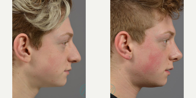 Case 10436 - Woman treated with Septoplasty