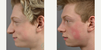 Case 10437 - Woman treated with Septoplasty