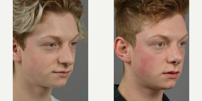 Case 10438 - Woman treated with Septoplasty