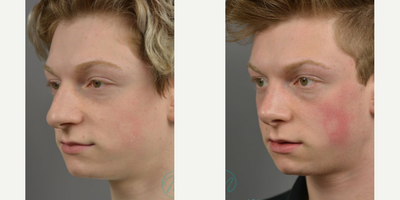 Case 10439 - Woman treated with Septoplasty