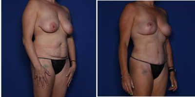 Case 1044 - 45-54 year old woman treated with Mommy Makeover, Breast Lift, Tummy Tuck