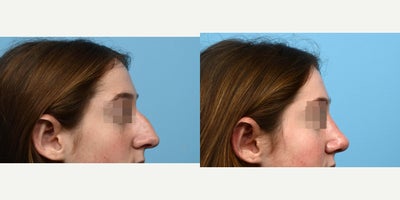 Case 10440 - 18-24 year old woman treated with Septoplasty