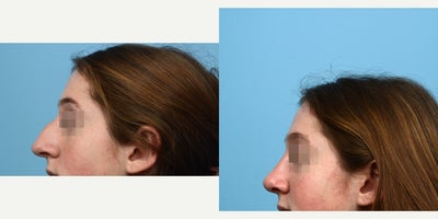 Case 10441 - 18-24 year old woman treated with Septoplasty