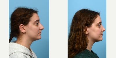 Case 10442 - 18-24 year old woman treated with Septoplasty
