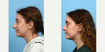 Case 10445 - 18-24 year old woman treated with Septoplasty