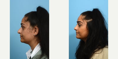 Case 10448 - 25-34 year old woman treated with Septoplasty