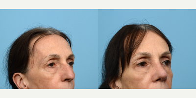 Case 10449 - 55-64 year old woman treated with Septoplasty