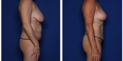 Case 1045 - 45-54 year old woman treated with Mommy Makeover, Breast Lift, Tummy Tuck