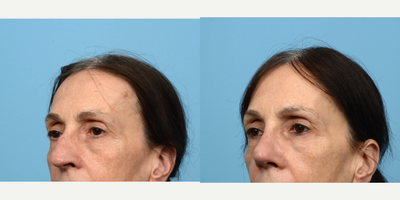 Case 10450 - 55-64 year old woman treated with Septoplasty