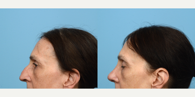 Case 10451 - 55-64 year old woman treated with Septoplasty