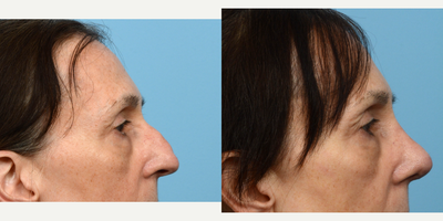 Case 10452 - 55-64 year old woman treated with Septoplasty