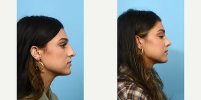 Case 10453 - 18-24 year old woman treated with Septoplasty