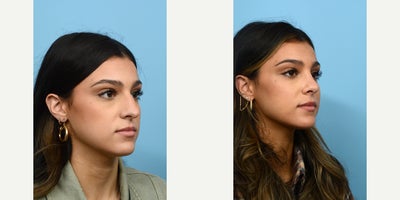 Case 10454 - 18-24 year old woman treated with Septoplasty