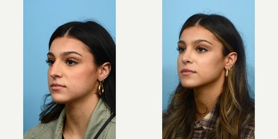 Case 10455 - 18-24 year old woman treated with Septoplasty