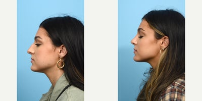 Case 10456 - 18-24 year old woman treated with Septoplasty