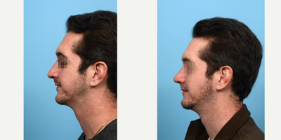 Case 10457 - 25-34 year old man treated with Septoplasty