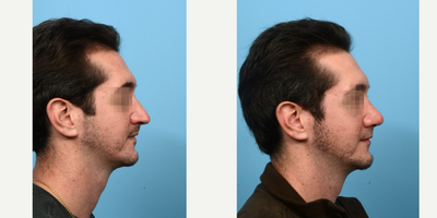 Case 10458 - 25-34 year old man treated with Septoplasty