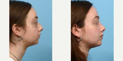 Case 10459 - 18-24 year old woman treated with Septoplasty