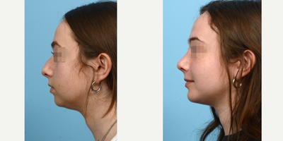 Case 10460 - 18-24 year old woman treated with Septoplasty