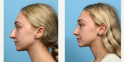 Case 10461 - 18-24 year old woman treated with Septoplasty