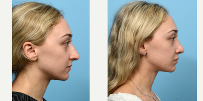 Case 10462 - 18-24 year old woman treated with Septoplasty