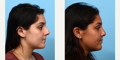 Case 10463 - 18-24 year old woman treated with Septoplasty