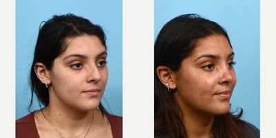 Case 10464 - 18-24 year old woman treated with Septoplasty