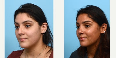 Case 10465 - 18-24 year old woman treated with Septoplasty