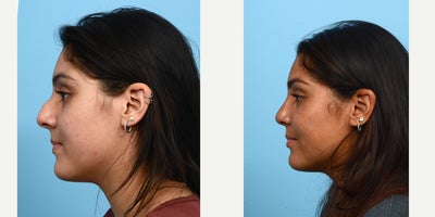 Case 10466 - 18-24 year old woman treated with Septoplasty