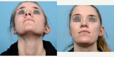 Case 10467 - 18-24 year old woman treated with Septoplasty