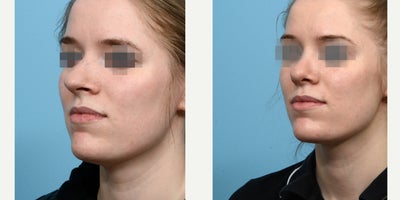 Case 10468 - 18-24 year old woman treated with Septoplasty