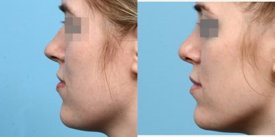 Case 10469 - 18-24 year old woman treated with Septoplasty