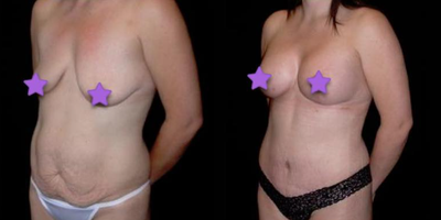 Case 1047 - Woman treated with Tummy Tuck