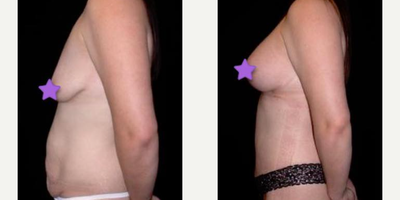 Case 1048 - Woman treated with Tummy Tuck