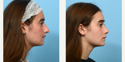 Case 10488 - 17 or under year old woman treated with Septoplasty