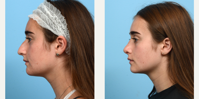 Case 10489 - 17 or under year old woman treated with Septoplasty