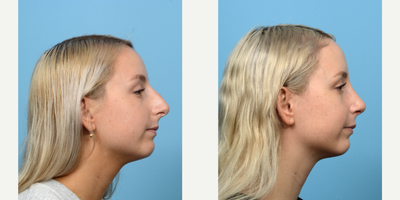 Case 10495 - 18-24 year old woman treated with Septoplasty
