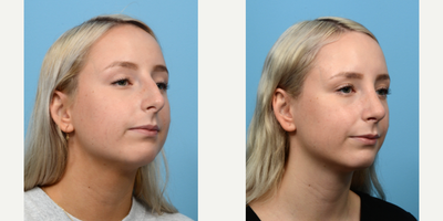 Case 10497 - 18-24 year old woman treated with Septoplasty