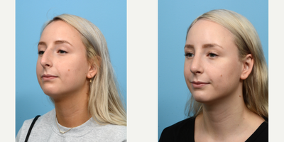 Case 10498 - 18-24 year old woman treated with Septoplasty