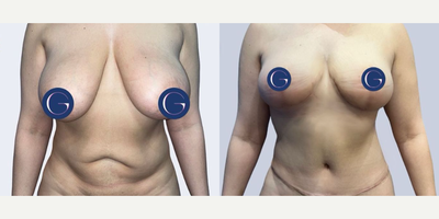 Case 105 - Woman treated with Breast Lift with Implants, Tummy Tuck, Mommy Makeover