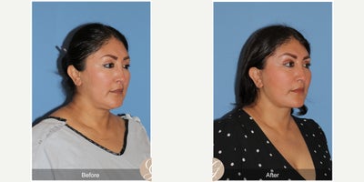 Case: 10500 - before and after photo of 47 year old woman treated with Deep Plane Facelift, Neck Lift, Brow Lift, Buccal Fat Removal, MACS Facelift by Kevin Sadati, DO