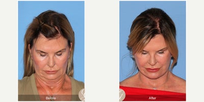 Case: 10503 - before and after photo of 66 year old woman treated with Deep Plane Facelift, Facelift, Neck Lift, MACS Facelift by Kevin Sadati, DO