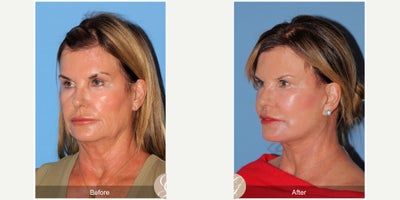 Case: 10504 - before and after photo of 66 year old woman treated with Deep Plane Facelift, Facelift, Neck Lift, MACS Facelift by Kevin Sadati, DO